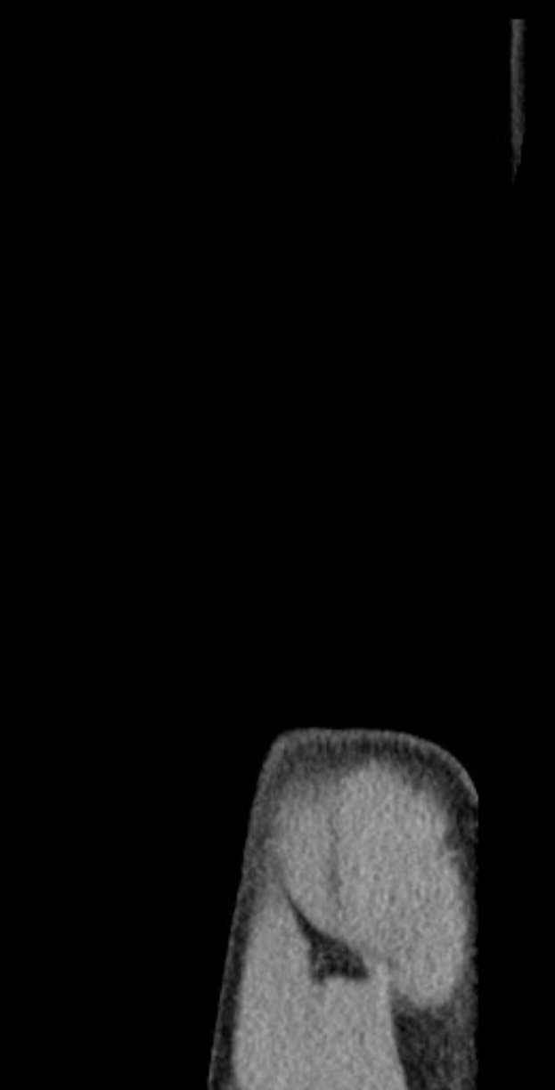 Schwarß-weßer MR-Aufnahme, die detaillierte Anatomie eines Patientenknies zeigt.