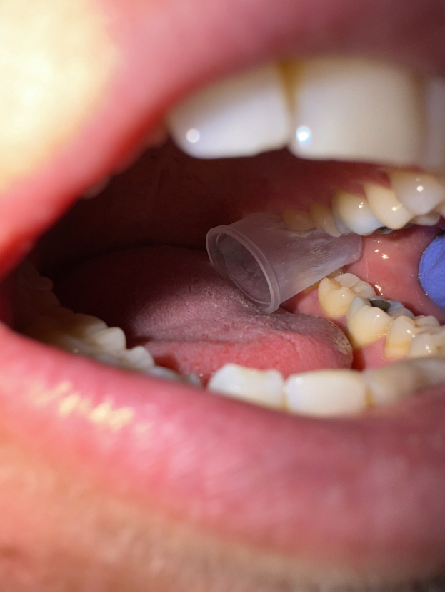 Nahaufnahme eines Mundes mit einem fehlenden Zahn und einem Dentalimplantat in der Mitte.