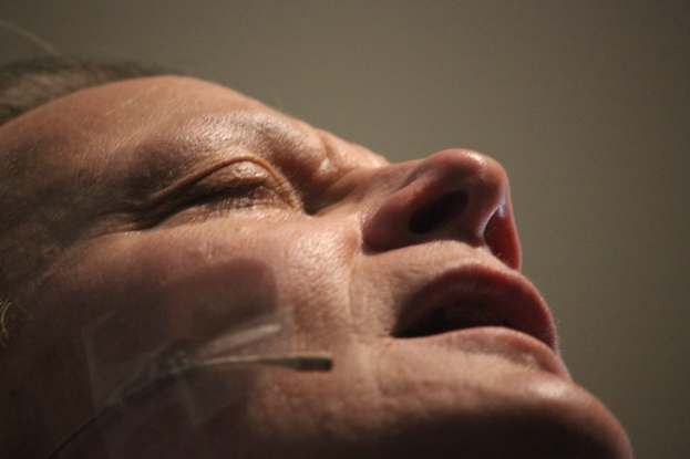 Nahaufnahme eines Frauengesichts während einer Gesichtsstraffung mit mehreren Nadeln in der Nase, die Augen geschlossen.